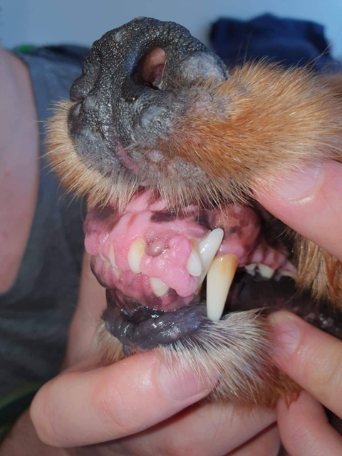 Figura 4. Hiperplazie gingivala consecutivă ciclosporinei.